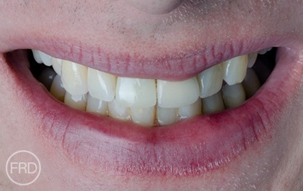 full dental implants