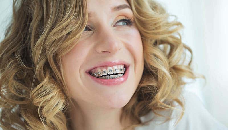 Do Teeth Move Back After Braces?