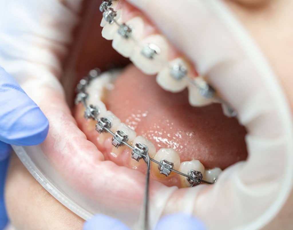 Long-Term Stability: How Long Does It Take to Straighten Teeth?