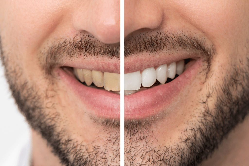 Yellow Teeth comparison - Fulham Road Dental 