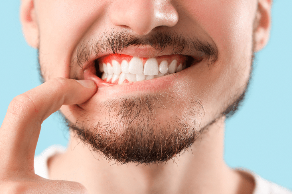 Periodontal Disease - Fulham Road Dental